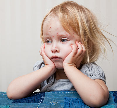 baby rash around mouth and bum